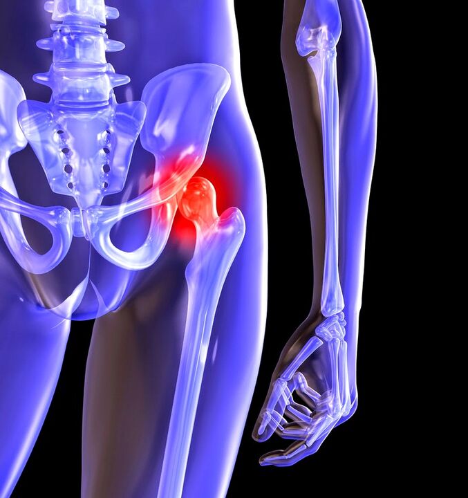 Deformation of hip arthrosis joint