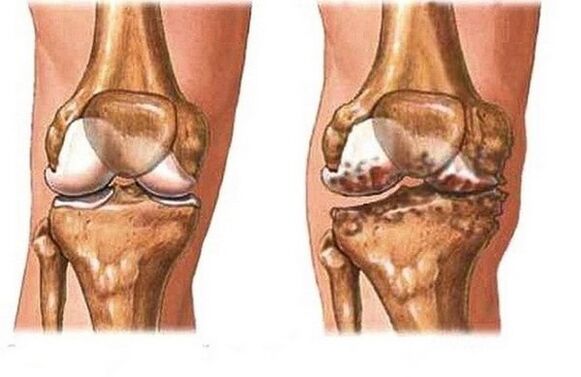 Healthy and inflamed joint