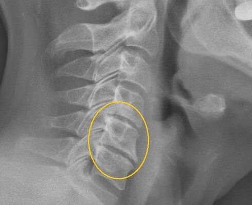 Osteochondrosis of the cervical spine on x -ray