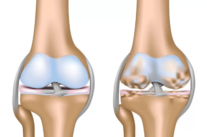 Deformation of knee arthrosis joint
