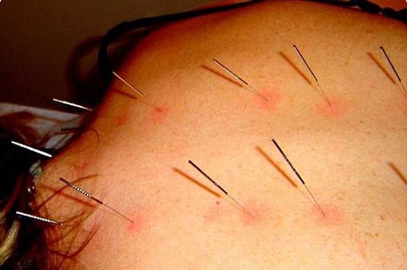 Acupuncture - a method of treating cervical osteochondrosis