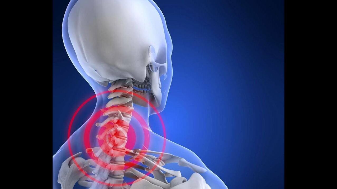 Osteochondrosis of the cervical vertebrae